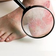 Masalah Kulit Eczema vs Psoriasis, Apa Perbedaannya?