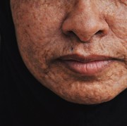 Simak 4 Perbedaan antara Kulit Bopeng dan Kulit Bertekstur, Banyak yang Masih Salah!