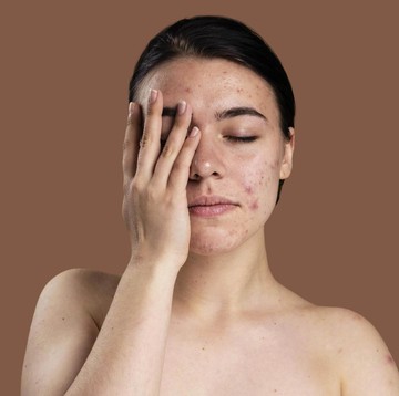 img-title Simak Perbedaan Kulit Sensitif dan Reaksi Alergi, Serupa Tapi Tak Sama