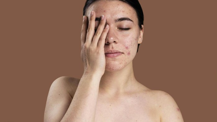 Simak Perbedaan Kulit Sensitif dan Reaksi Alergi, Serupa Tapi Tak Sama Simak Perbedaan Kulit Sensitif dan Reaksi Alergi, Serupa Tapi Tak Sama