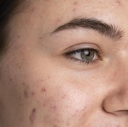 Bekas Jerawat Kemerahan dan Flek Hitam, Cara Perawatannya Beda atau Sama?