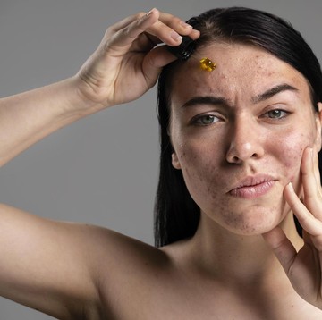 Skincare dan Perawatan Wajah Jadi Sia-sia: 4 Kebiasaan Buruk Ini Bikin Bekas Jerawat Susah Hilang!