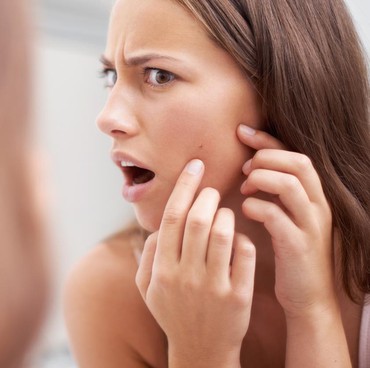 Kenali Penyebab dan Cara Menghilangkan Jerawat secara Alami