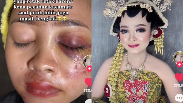 Jelang pernikahan, wajah pengantin ini penuh luka dan sukses bikin pangling saat hari pernikahan.