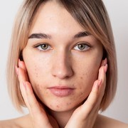 5 Pilihan Skincare Lokal untuk Atasi Jerawat, Wajib Dicoba!