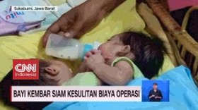 VIDEO: Bayi Kembar Siam Kesulitan Biaya Operasi