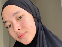 Pejuang Jerawat, Wajah Nissa Sabyan Sampai Dibalut Perban
