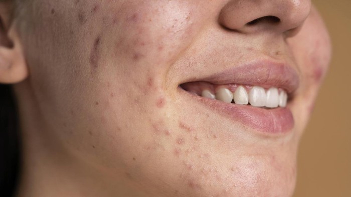 Jerawat Tak Kunjung Hilang? Coba Atasi dengan Ramuan Merah Ini!