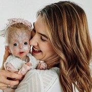Mengenal Penyakit Progeria, Salah Satu Kelainan yang Membuat Anak-anak Terlihat Tua Sebelum Waktunya