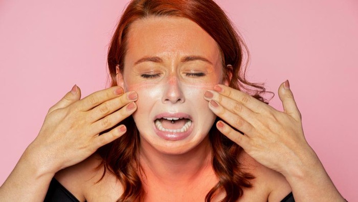 Kulit Gosong Akibat Terbakar Matahari? Hati-hati, 4 Hal Ini Jangan Sampai Kamu Lakukan!