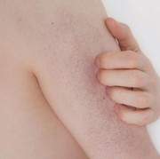 Sering Dialami oleh Remaja, Ketahui  Masalah Kulit Keratosis Pilaris atau Chicken Skin