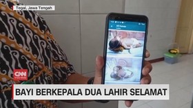 VIDEO: Bayi Berkepala Dua Lahir Selamat