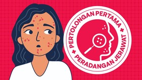 INFOGRAFIS: Pertolongan Pertama pada Jerawat