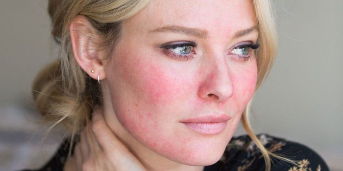 Rosacea/