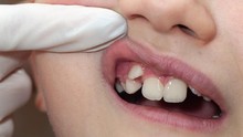 Hoax Mencabut Gigi Atas Sebabkan Kebutaan
