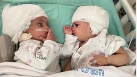 Ahli Bedah Muslim Berhasil Operasi Bayi Kembar Siam Israel