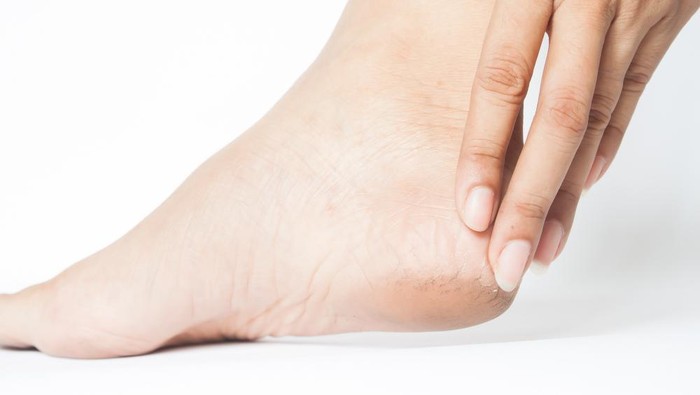 5 Rekomendasi Produk Ini Atasi Masalah Tumit Pecah-pecah dan Kasar, Harganya Cuma Rp 10 Ribuan!