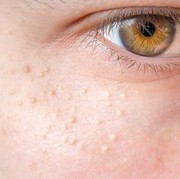 BeauPicks: Bukan Ditutupi Pakai Makeup, 5 Skincare Ini Bisa Lenyapkan Masalah Milia di Area Mata