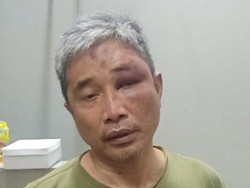 Dialami Muhammad Kace Usai Dijotos Irjen Napoleon, Lebam Bisa Separah Apa?