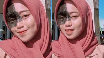 TANDA LAHIR DI WAJAH JUSTRU BIKIN IKA PERCAYA DIRI