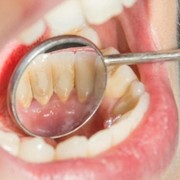 12 Cara Hilangkan Karang Gigi Secara Alami di Rumah, Bisa Dilakukan Sendiri