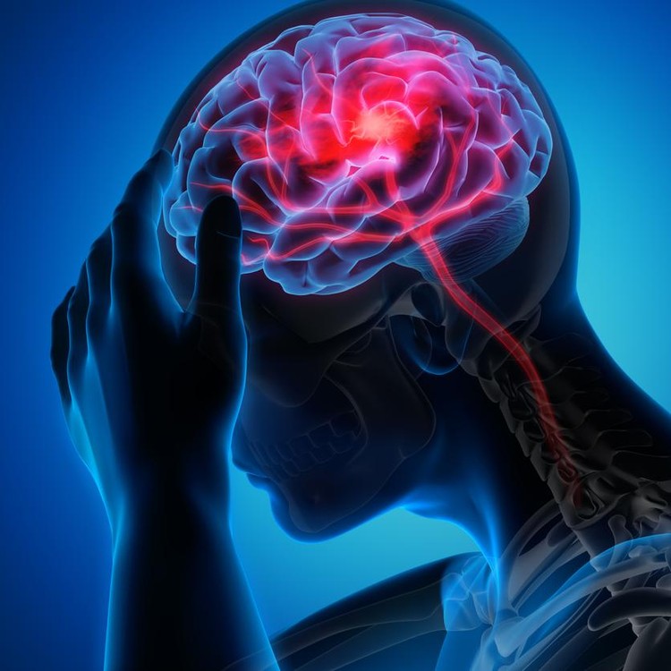 Ilustrasi Pendarahan Otak Medical illustration of a brain with stroke symptoms