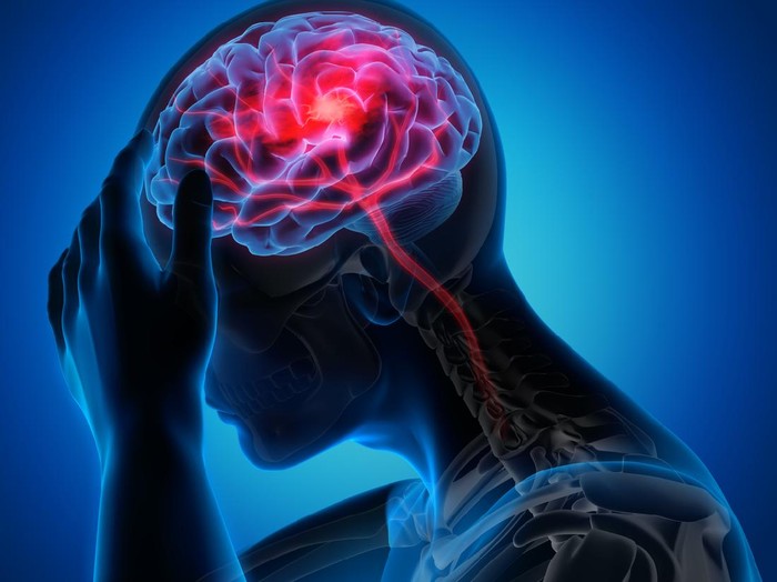 Medical illustration of a brain with stroke symptoms