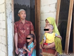 Idap Iktiosis Lameral, Kakak-Adik di Boyolali Kulitnya Bersisik Pecah-pecah