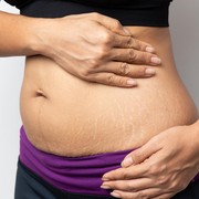 Tanpa Bahan Kimia, 6 Cara Alami Ini Dipercaya Efektif Menghilangkan Stretch Mark