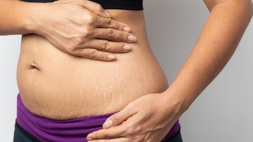 MENGATASI STRETCH MARK