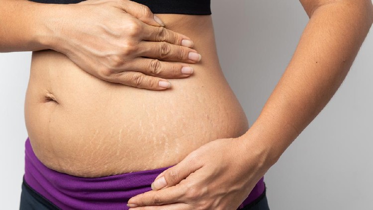 Stretch mark Stretch mark
