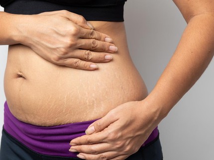 10 Cara Menyamarkan Stretch Mark setelah Melahirkan secara Alami, Cobain Yuk