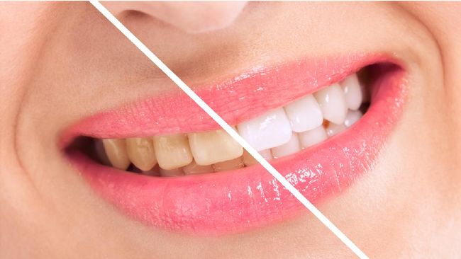 Sejumlah kebiasaan dapat membuat gigi menguning. Hindari kebiasaan yang bikin gigi kuning berikut ini.