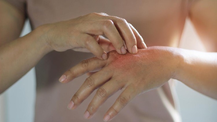 Ilustrasi Kulit Gatal Healthcare and medical concept. Female scratching the itch on her hand, cause of itching from skin diseases, dry skin, allergy, chemical, allergic to detergent or dishwashing liquid and dermatitis, insect bites, burned, drug. Health problem.