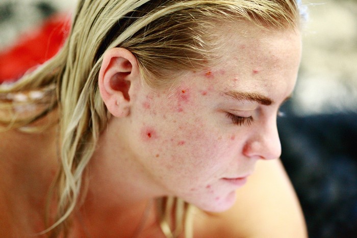 Gejala penyakit kulit rosacea