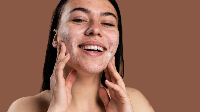 Kenalan dengan Rosacea, Penyakit Kulit Seperti Jerawat yang Tidak Bisa Disembuhkan