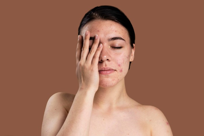 Rosacea tidak bisa disembuhkan