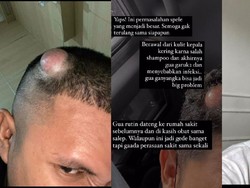 Bikin Syok! Viral Benjolan di Kepala Gegara Sering Digaruk Sampai Harus Operasi