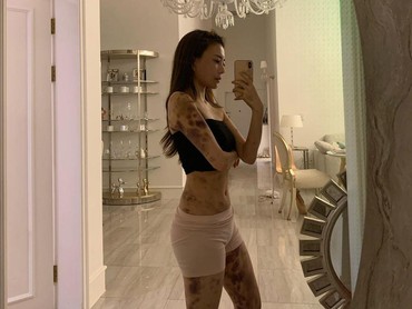 Youtuber Korea Ini Alami Lebam di Sekujur Tubuh Usai Disuntik Dokter
