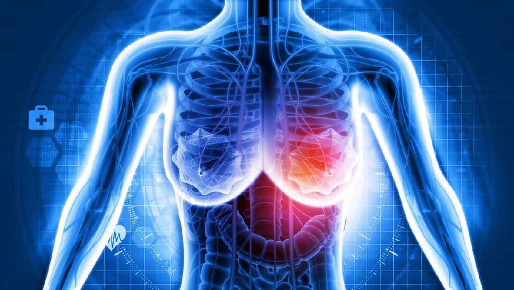 Waspadai Benjolan di Payudara, Kenali Gejala Tumor Sejak Dini