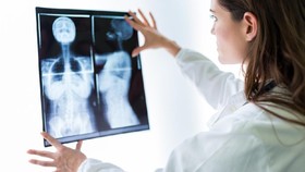 Dokter: Kanker Payudara Banyak Dialami Remaja dan Dewasa Muda