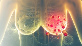 Pasien Kanker Payudara Terus Meningkat, Deteksi Dini Penting Dilakukan