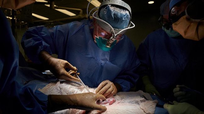 IlmuwanAS sukses melakukan transplantasi ginjal babi ke manusia. Terobosan ini dinilai mampu jadi alternatif untuk pasien gagal ginjal.