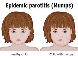 Pengertian Penyakit Parotitis: Penularan, Pencegahan hingga Apakah Bisa Sembuh?