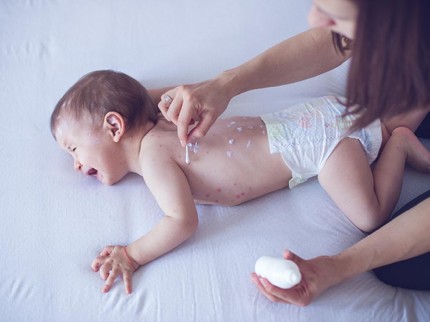 Gejala hingga Komplikasi Cacar Air pada Anak, Simak Cara Pengobatan yang Tepat