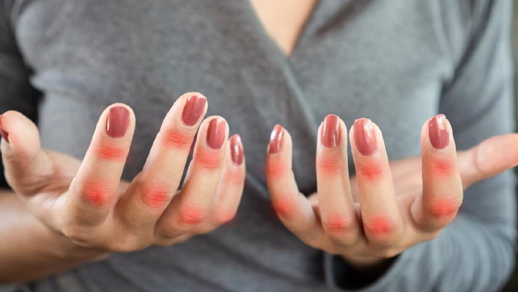 Ilustrasi Jenis Penyakit Autoimun closeup woman suffering from hand and finger pain can be use for knuckle , joint pain and gout concept