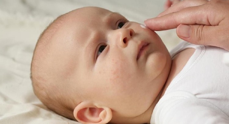 CARA MENGOBATI JERAWAT DAN EKSIM PADA BAYI Jerawat dan eksim memang merupakan masalah kulit yang sangat umum dialami bayi. Meski begitu, penting bagi Bunda mengetahui perbedaan antara keduanya.