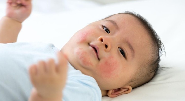 Meski Tampak Mirip, Penanganan Jerawat dan Eksim pada Kulit Bayi Ternyata Berbeda Bun Jerawat dan eksim memang merupakan masalah kulit yang sangat umum dialami bayi. Meski begitu, penting bagi Bunda mengetahui perbedaan antara keduanya.