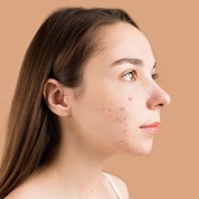 Jangan Lakukan 3 Hal Ini Jika Tak Ingin Jerawat Makin Parah