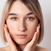 BeauPicks: 3 Pilihan Serum dari Brand Lokal Somethinc untuk Pudarkan Noda Bekas Jerawat